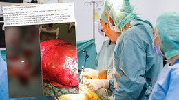 Lekarze z Zielonej Góry usunęli guza ważącego 42 kg (screen: Facebook/Szpital Uniwersytecki w Zielonej Górze)