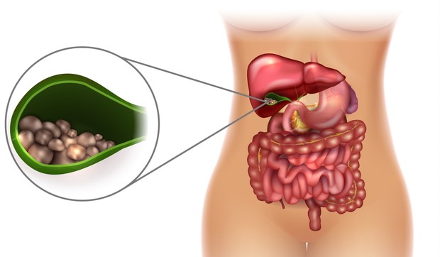 Porcelanska žučna kesa