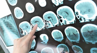 6 indigenous Africans develop stroke every minute, every hour – Expert