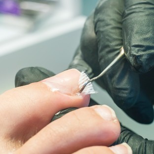Benőtt köröm okozta fájdalmak: nemcsak a szűk cipő lehet a hibás!