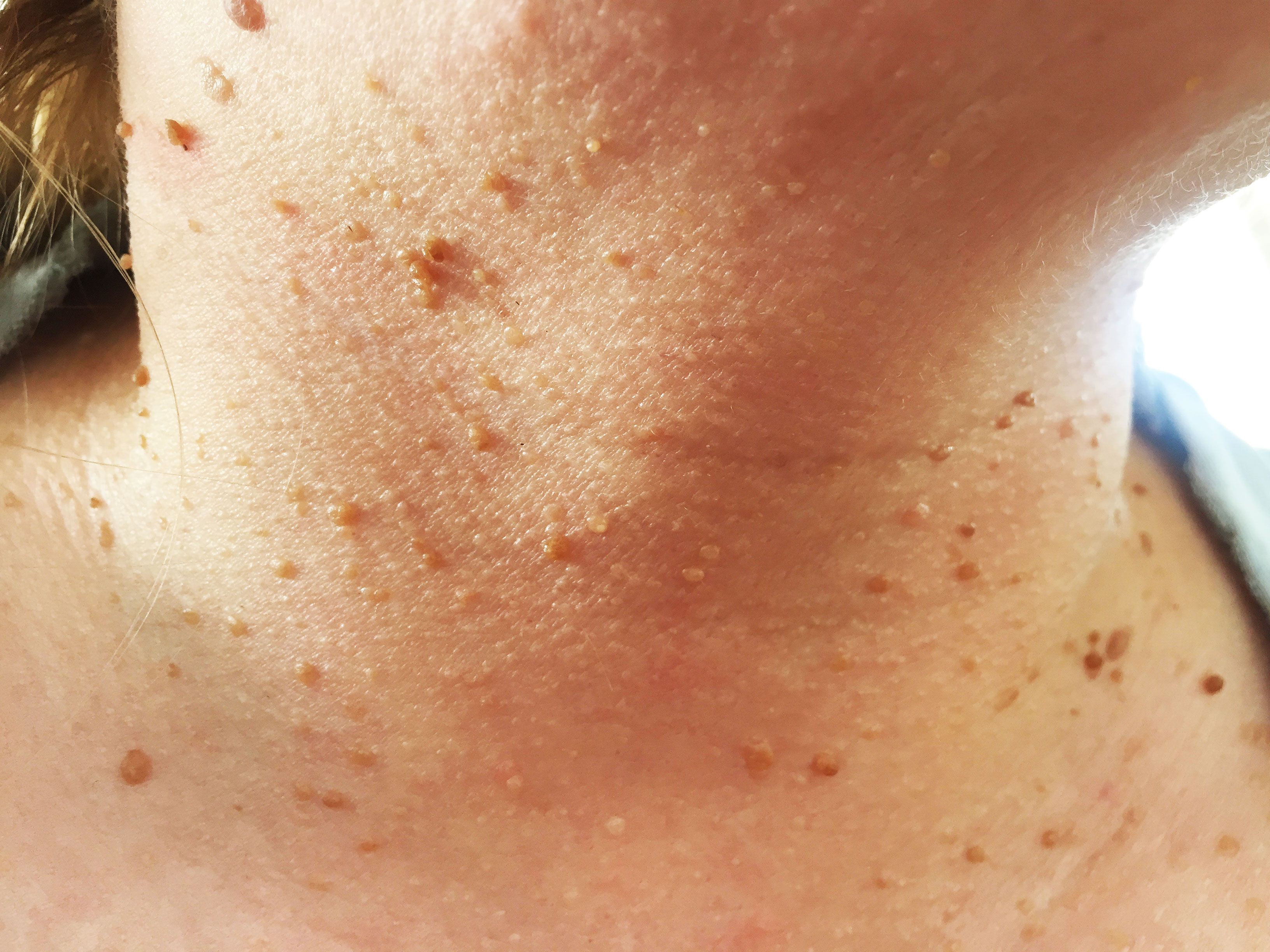 12 Bumps On Your Skin That Are Totally Normal—and You Shouldn T Pop Pulse Nigeria
