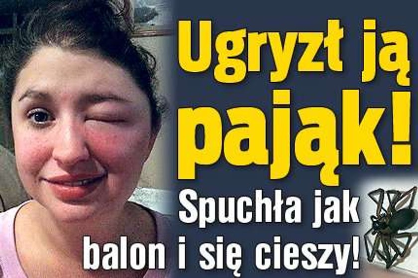 Ugryzł ją pająk! Spuchła jak balon i się cieszy!