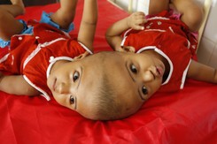 Dziewczynki połączone głowami. Chirurdzy sprawdzają, czy można je rozdzielić