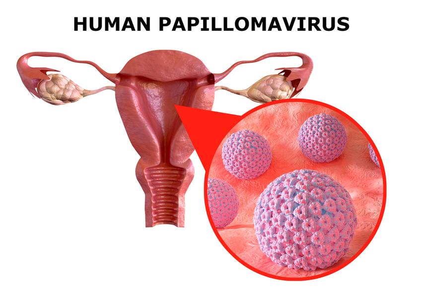 A HPV (humán papillomavírus) fertőzés tünetei, kezelése