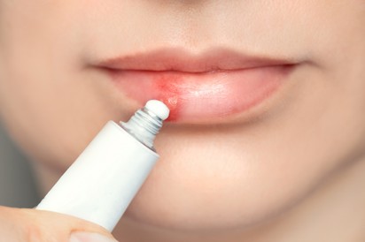 Mi tehetünk ajakherpesz ellen házilag? Ezek a legjobb természetes gyógymódok