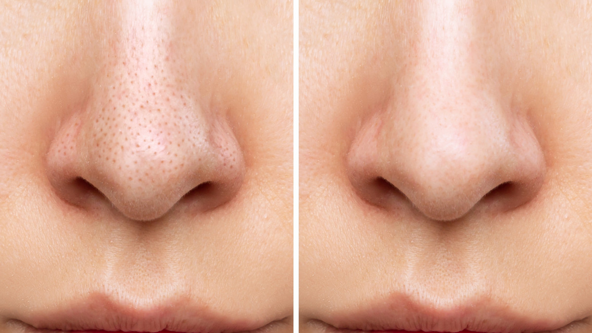 Jak usunąć wągry z nosa, brody i policzków? Zobacz polecane kosmetyki