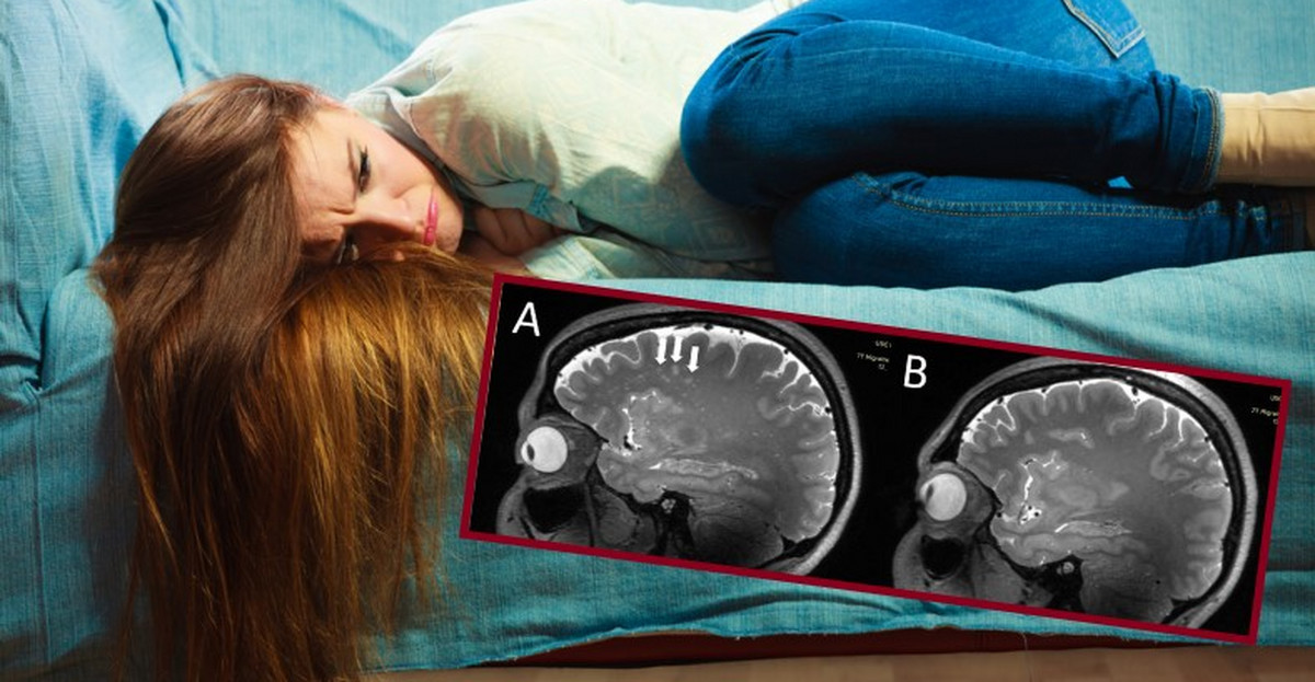 Co się dzieje w mózgu osoby z migreną? "Te zmiany nigdy wcześniej nie były zgłaszane" 