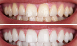 Jak skutecznie wybielić zęby? Zdradzają stomatolodzy