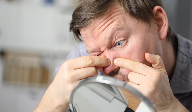 Prisilno istiskivanje mitesera može da iziritira područje na kome se nalazi