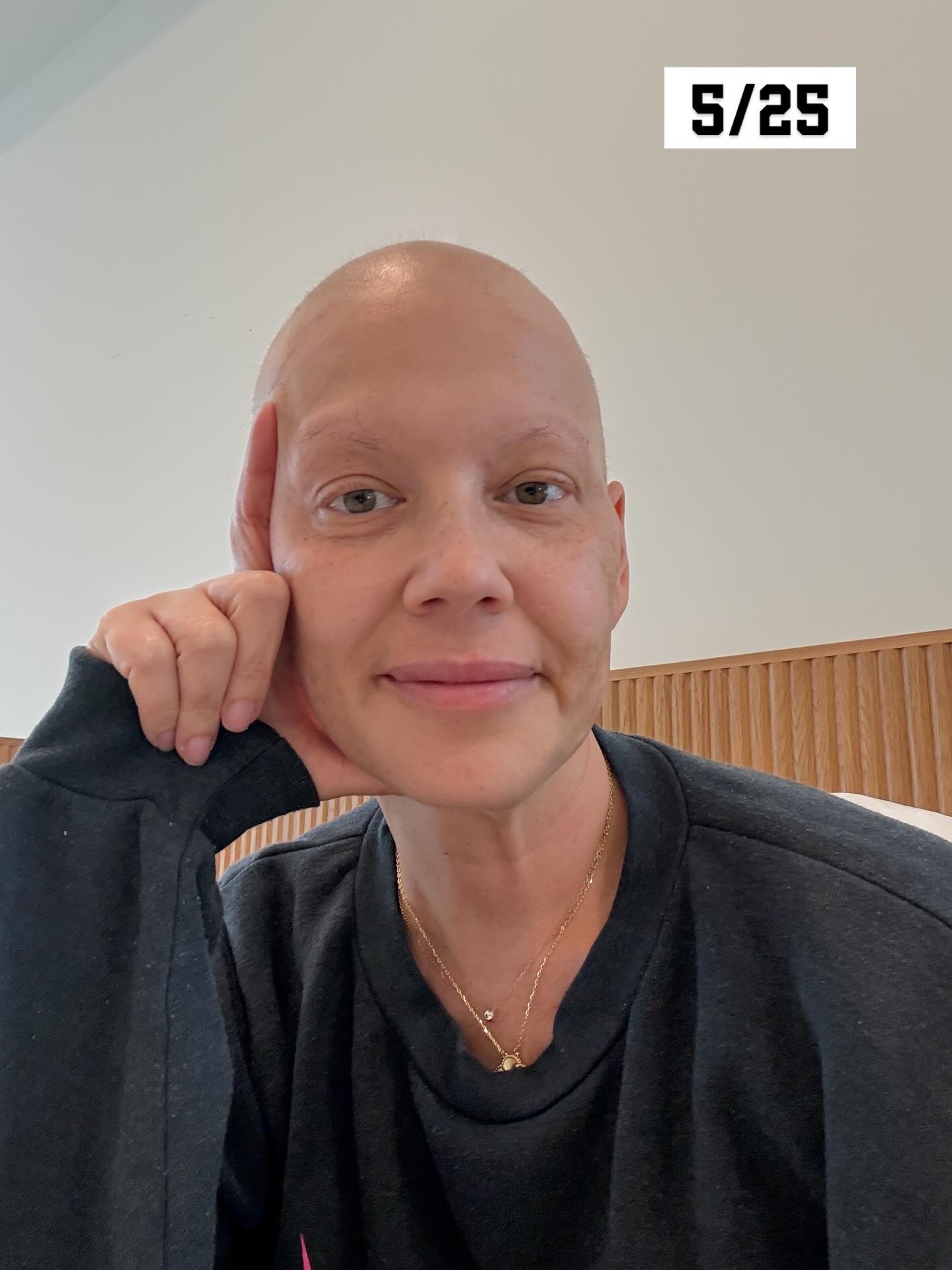 Louise Altese museli odstrániť sedem orgánov. 