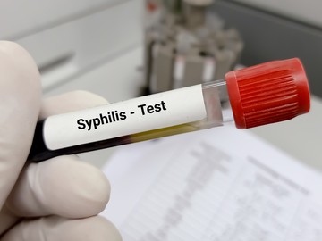 A szifilisznek három stádiumát különböztjük meg. A teljes gyógyulás az első két stádiumban még elérhető, de az újrafertőződés bekövetkezhet, ha a szexuális partnerek gyakran cserélődnek.