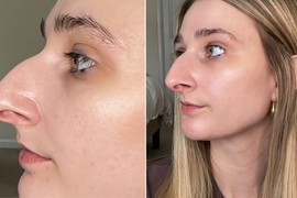 "Dala sam 10.000 evra za OPERACIJU NOSA": Plastični hirurg napravio REMEK DELO, ljudi gledaju slike PRE I POSLE i ne veruju - "Zvali su me Tukan, sad ne mogu da se odbranim od komplimenata"