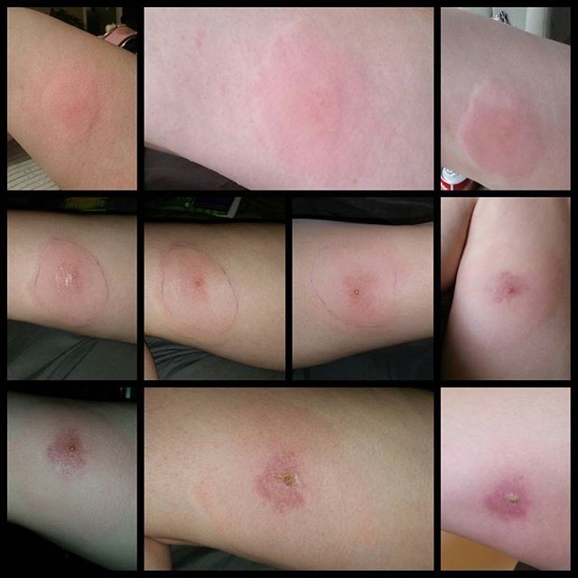 Do You Have A Spider Bite These Photos Can Help You Tell Pulse Ghana