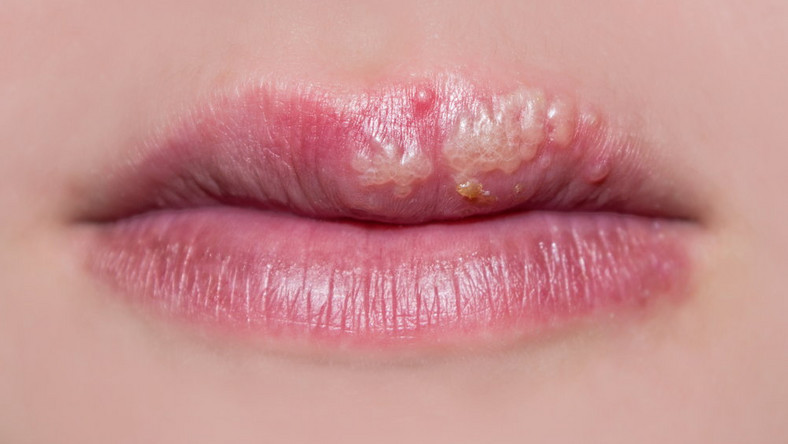 Opryszczka na ustach (wargowa) - fazy, leczenie, jak pozbyć się wirusa