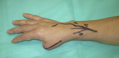 Zrobili pacjentowi kciuka z palca u nogi