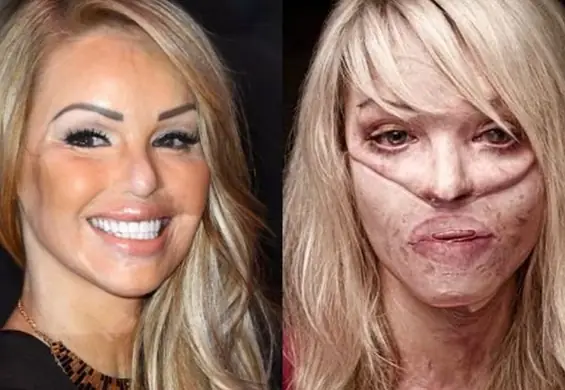 Katie Piper - wywiad z modelką, która po oblaniu kwasem straciła twarz i dawne życie. Po ataku chciała umrzeć. A dziś?