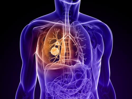 Rak płuca - ok. 21 tys. zgonów rocznie - miejsce 4.