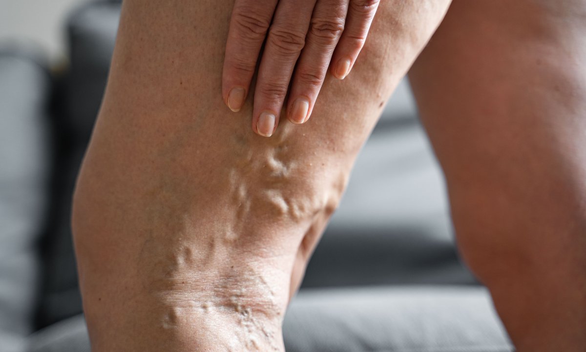 Ciężkie nogi i żylaki? Ten tani balsam błyskawicznie przynosi ulgę i wzmacnia naczynka