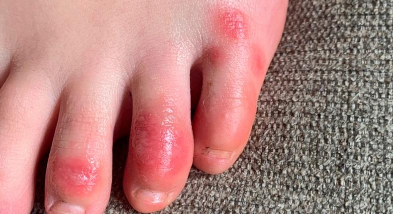 This April 3, 2020 photo provided by Northwestern University shows discoloration on a teenage patient's toes at the onset of the condition informally called