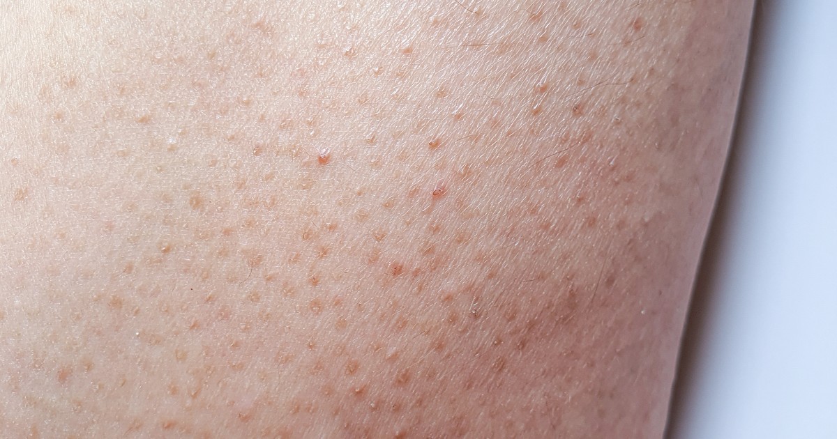 Rogowacenie okołomieszkowe. Co to jest?