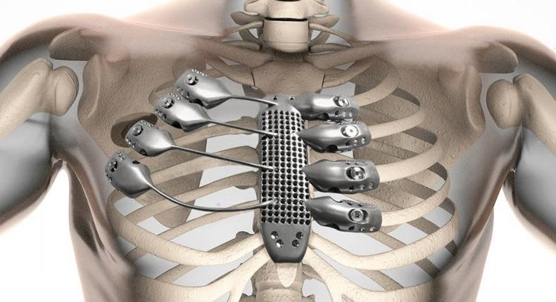 3D imagery showing the titanium rib cage in the patients body