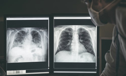 Jak wyglądają płuca po COVID-19?