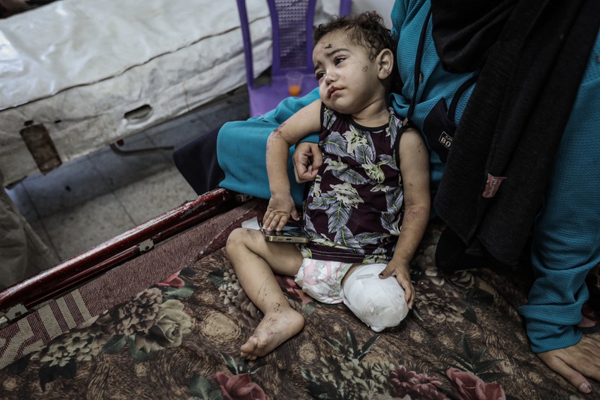 Palestinka Zejna Abdel Karim Abu Varda ima nepune dve godine i jedna je od 5.000 mališana koji su ostali invalidi tokom izraelskog bombardovanja