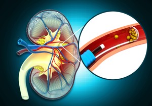 Kamen u bubregu jako boli kada dolazi do njegovog izbacivanja 