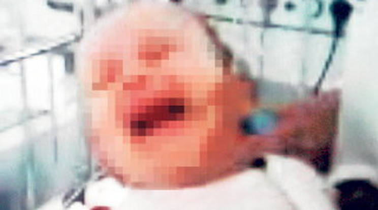 Betörték szülei az összeharapdált baba fejét