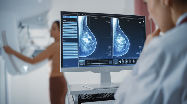 A mellrák a nők körében a leggyakrabban diagnosztizált daganatos betegség/Fotó: Shutterstock