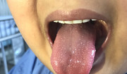 Objawy szkarlatyny. Zwróć uwagę na specyficzną wysypkę i "truskawkowy język"