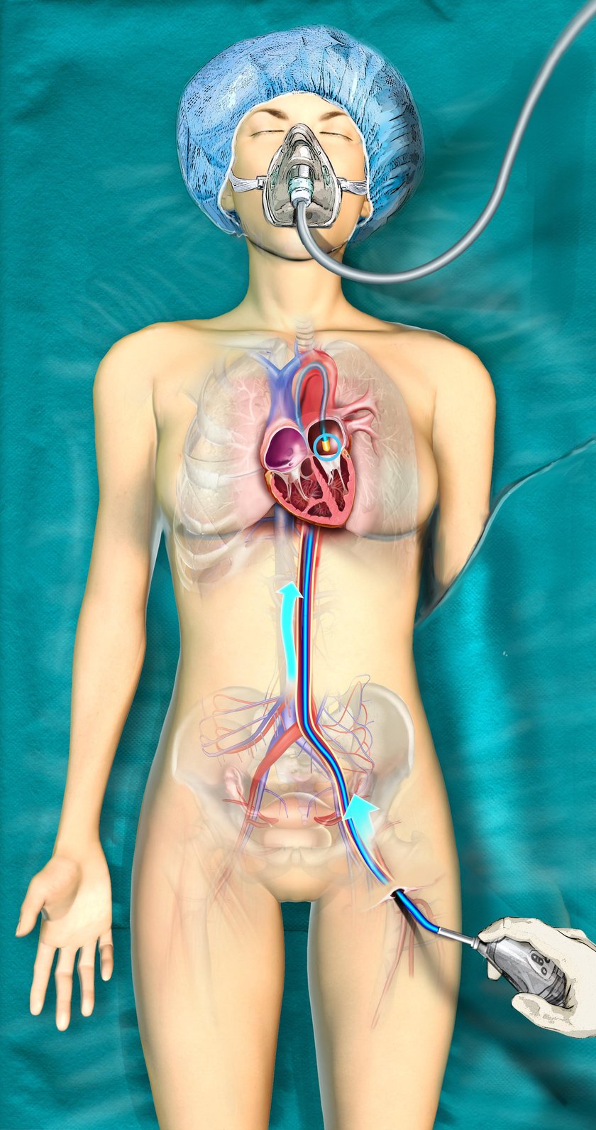 Kardiochirurdzy przeprowadzili zabieg przez udo pacjentki