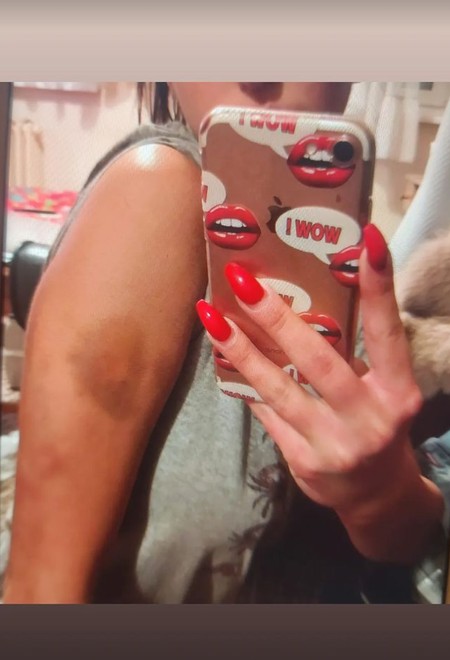 Maji telo puno modrica