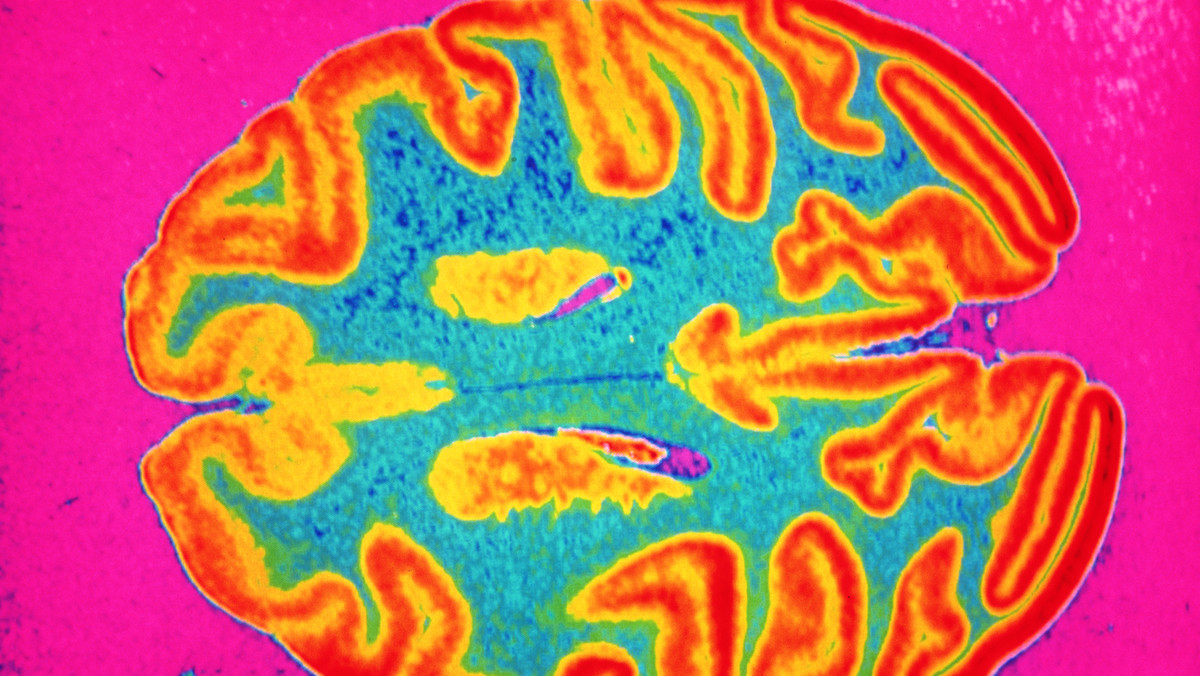 Czy alzheimerem można się zarazić? Wstrząsające odkrycie badaczy