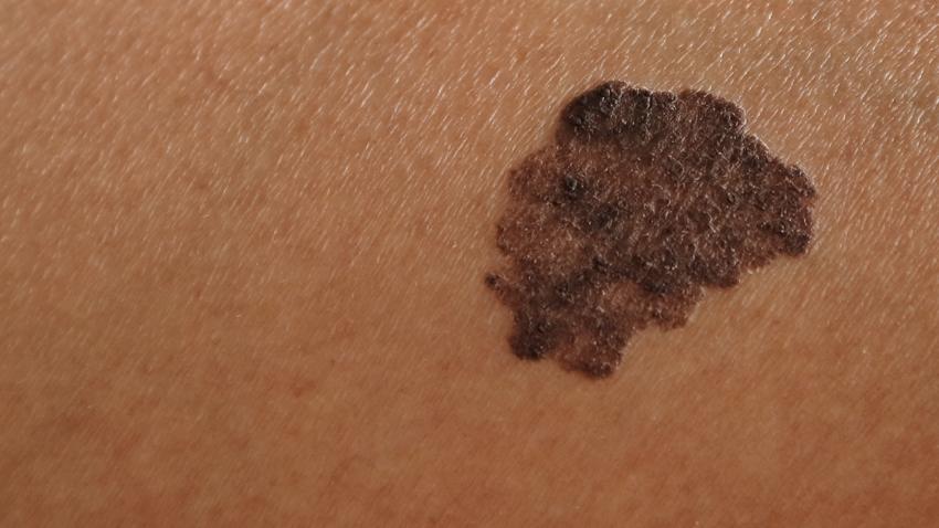 rák melanóma első korai jele bőrrák tünete áttét megelőtése