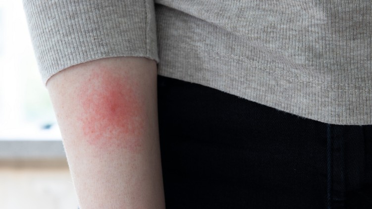 lyme-kór korai tünetei