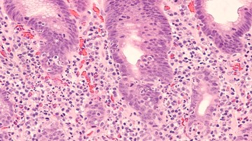 Mikroszkópos kép egy endoszkópos gyomor (gyomor) biopsziáról, amely a Helicobacter pylori, egyfajta bakteriális fertőzés okozta krónikus aktív gyomorhurutot (gyulladást) mutat.