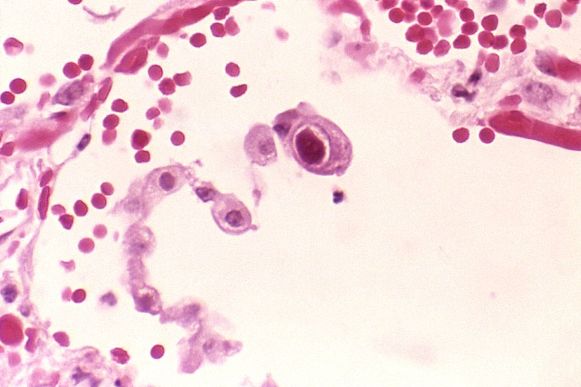 Cytomegalowirus