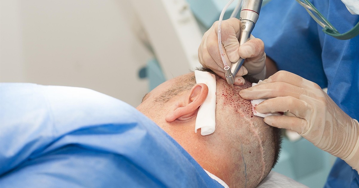 Pacjenci i chirurdzy odsłaniają kulisy przeszczepu włosów. "Znieczulenie było nieprzyjemne, ale znośne”