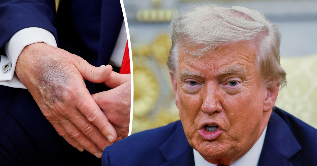 Dziwne plamy na dłoni Trumpa. Zauważono je kolejny raz