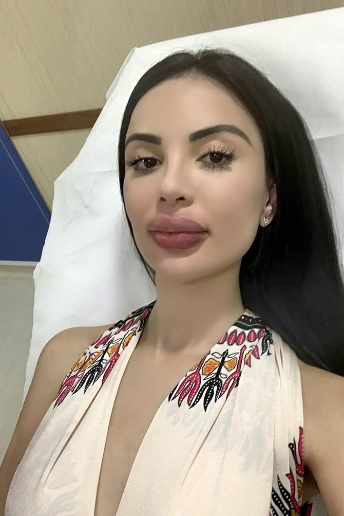 Burna reakcija nakon prevelike doze filera