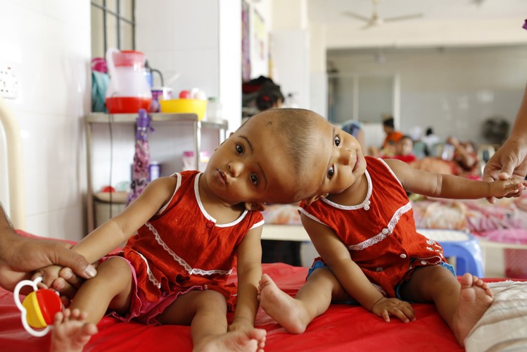 DZIEWCZYNKI ZŁĄCZONE GŁÓWKAMI. ZDOŁAJĄ JE ROZDZIELIĆ?