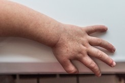 Wraca groźna choroba zakaźna. Pięć razy więcej przypadków niż rok temu