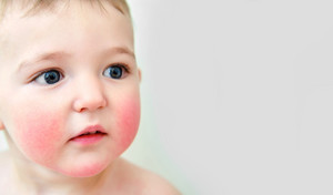 Ryzyko niedoborów żywieniowych u dzieci z alergią na białka mleka krowiego – jak mu zapobiegać?