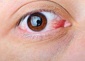 Figyeljen a jelekre - Súlyos betegségekre utalhat a véreres szem