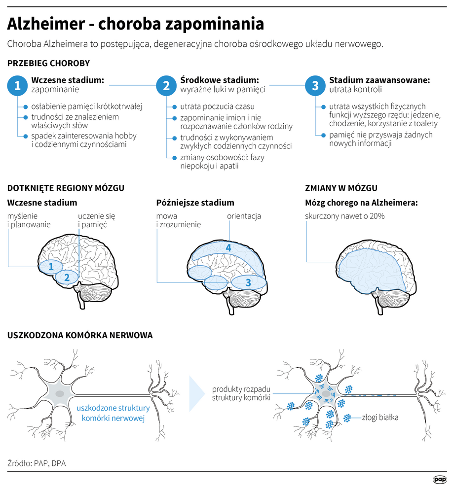 Efektem wydłużania się życia jest coraz częściej rozpoznawana choroba Alzheimera