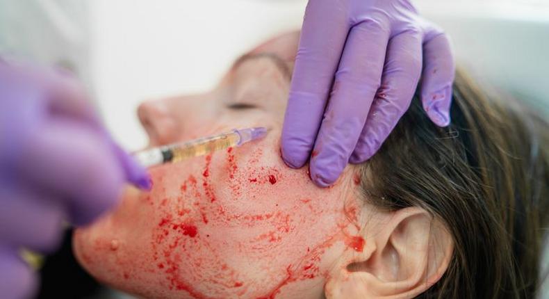 Wtf is a 'vampire facial' and is it even safe?