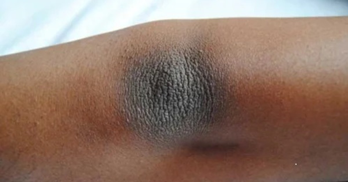 4 home remedies to get rid of dark knees and elbows Pulse Ghana