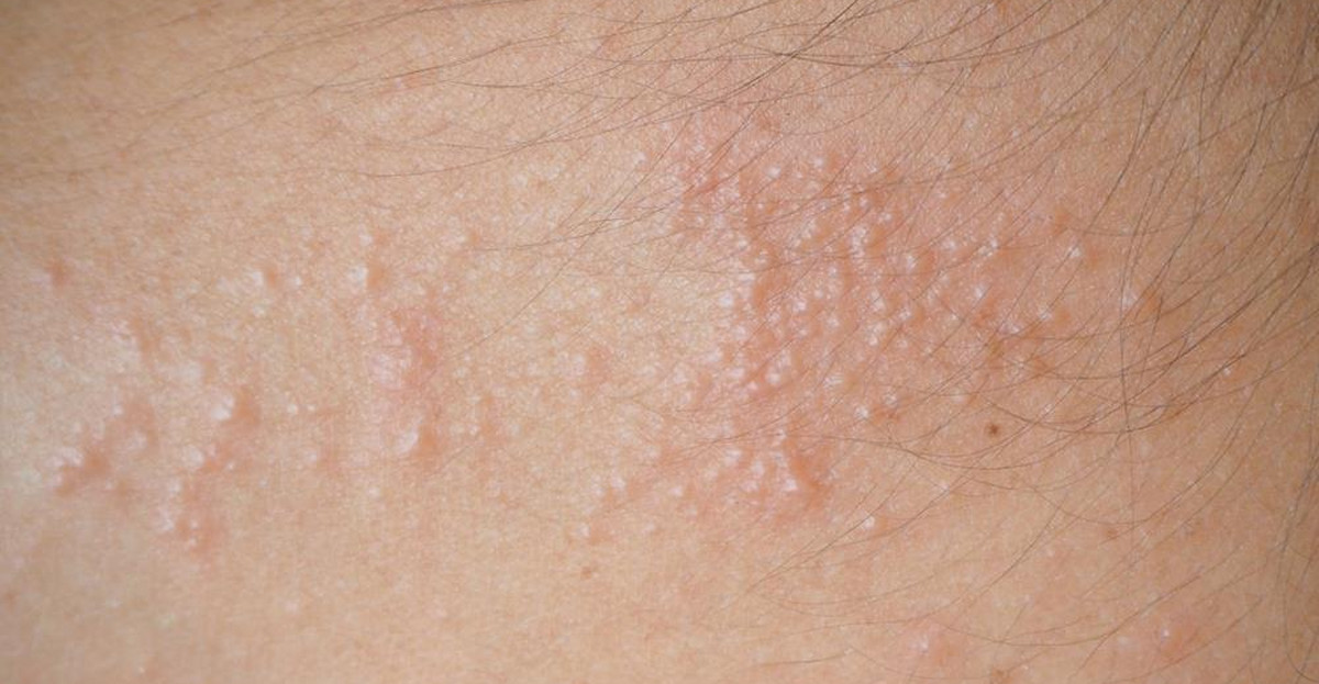 Potówki na twarzy dlaczego się pojawiają? Objawy i metody leczenia