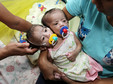 PHILIPPINES CONJOINED TWINS